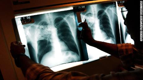Tuberculosis Fast Facts