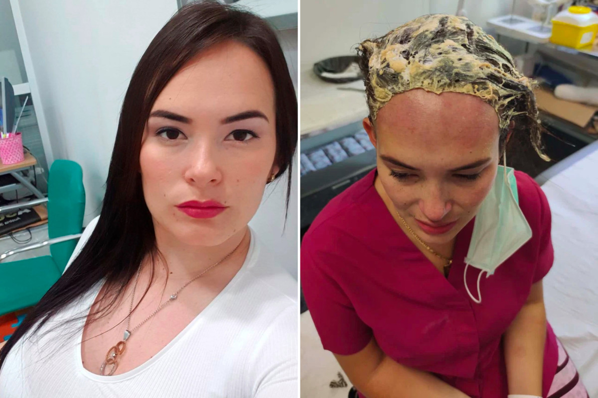 Woman suffers serious burns on her scalp from chemical attack