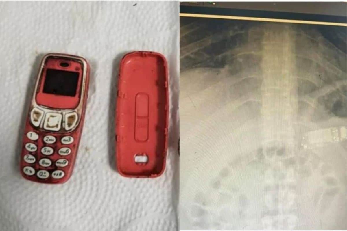   Dad!  The young man swallowed the whole Nokia 3310 phone;  The doctor was also shocked to see a scan on his abdomen

