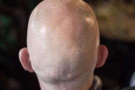 British court rules calling man 'bald' is sexual harassment;  Understand