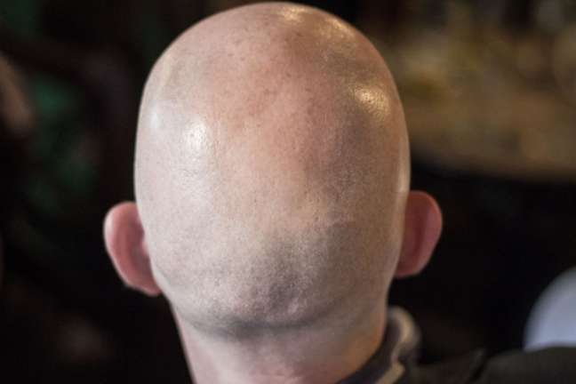 British Court Rules Calling Man Bald Is Sexual Harassment Understand 