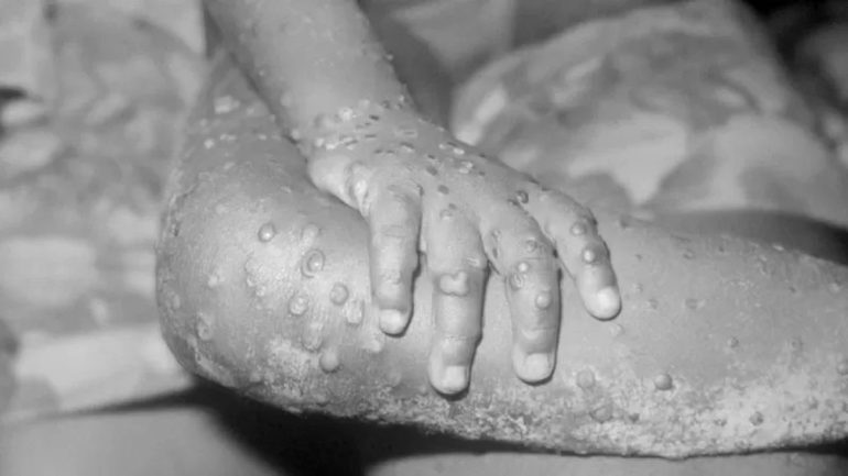 Monkeypox: What is known about the rare viral infection with two more cases in England |  Health