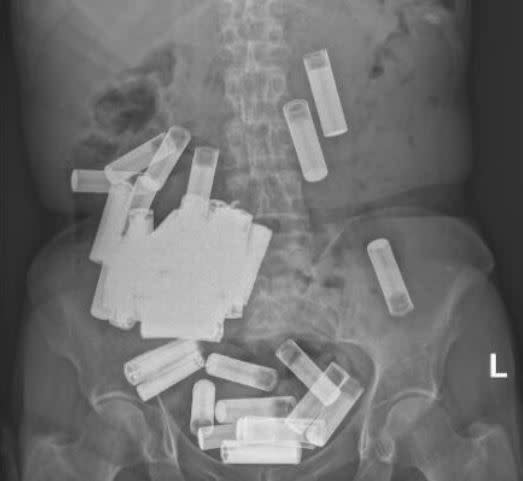 X-rays revealed large amounts of piles in the patient's stomach (Photo: DR/Irish Medical Journal)
